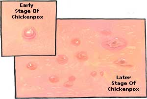 chicken-pox-picture
